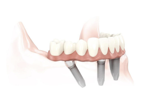 dental implants placed at an angle