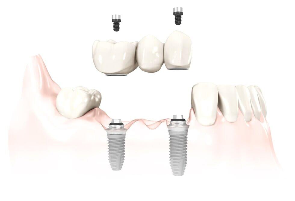 Illustration of placement of dental implants