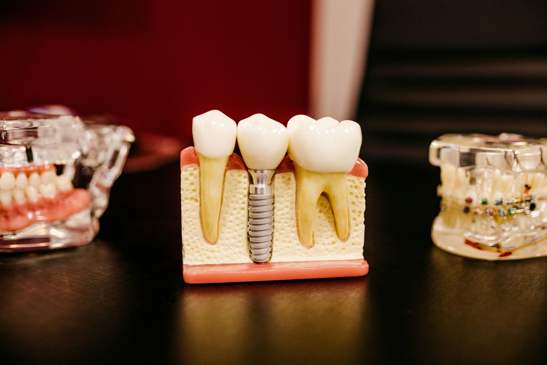 mock up of dental implant